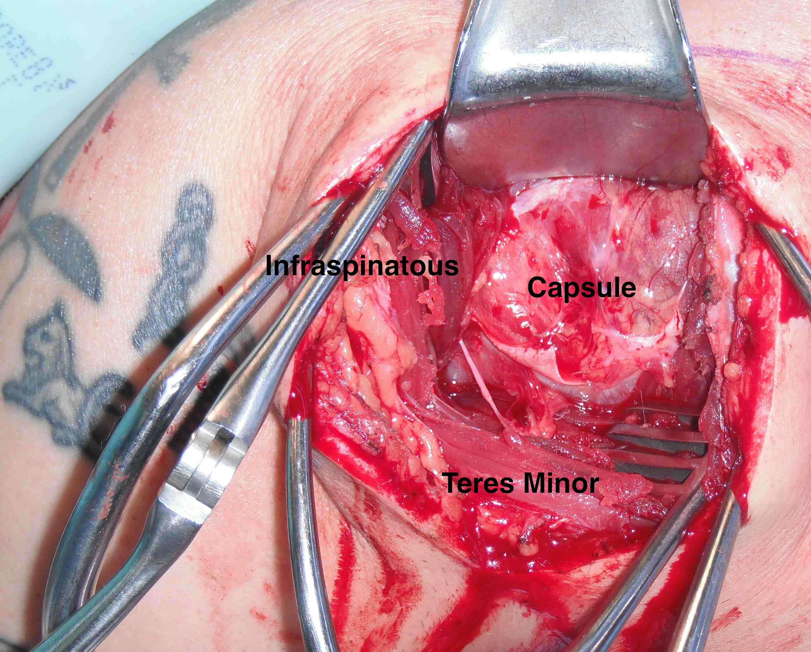 Shoulder Posterior Approach